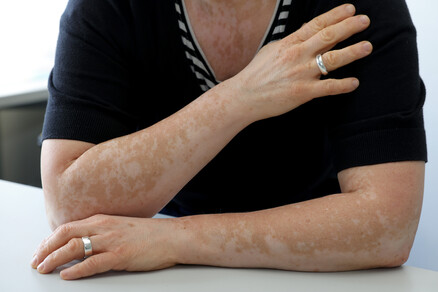 Arme mit Vitiligo-Erkrankung